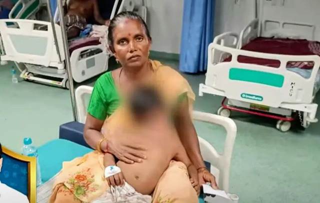 நாய் கடி