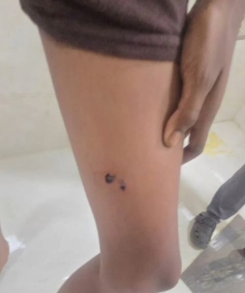 நாய் கடி