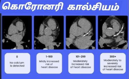 கொரோனரி கால்சியம் ஸ்கோர்
