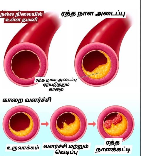 ரத்தநாள அடைப்பு